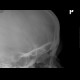Fissure of frontal bone: X-ray - Plain radiograph